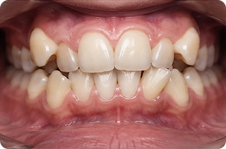 Caso adulto KSmile prima del trattamento